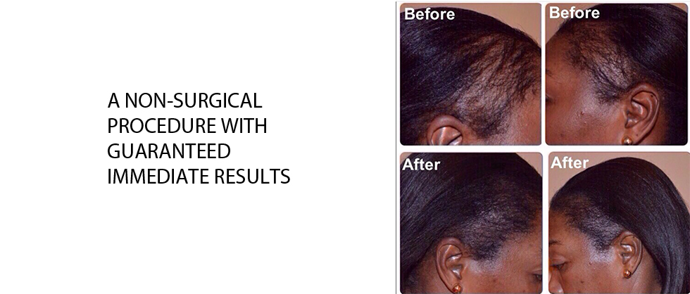 Before and after hair density treatment