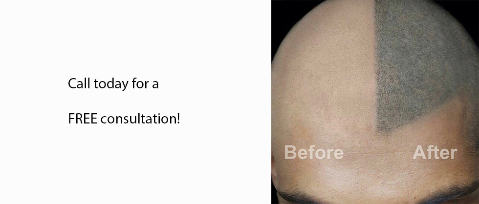 Before and after restored hairline