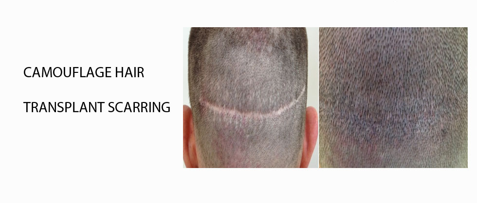 Hair transplant scar camouflage
