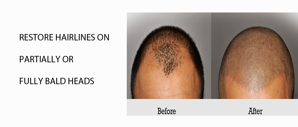 Scalp micropigmentation client
